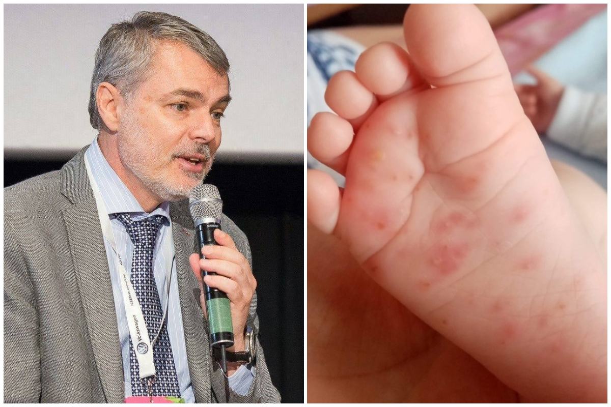 Dr. Mihai Craiu, avertisment legat de inmultirea cazurilor de sindrom mana-picior-gura. Ce sa nu dai niciodata copilul